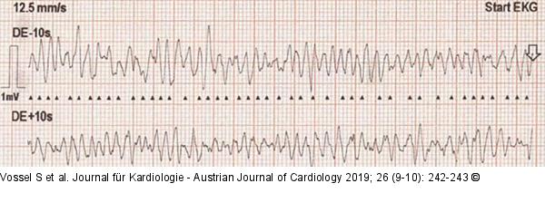 ECG