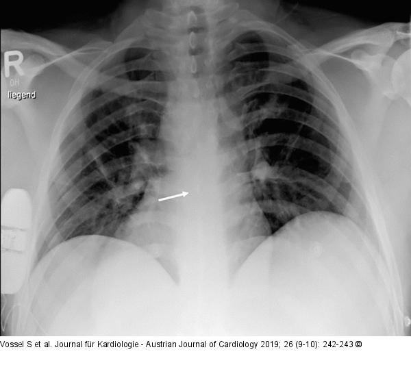 Chest x-Ray