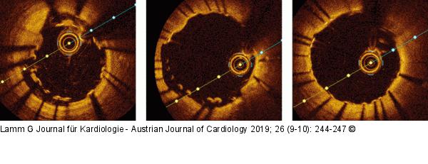 Stentunderexpansion/Strut-Malapposition und Ergebnis nach Optimierung