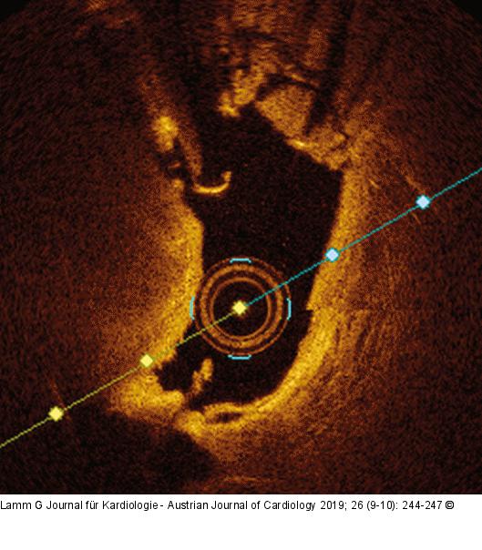 Stentthrombose