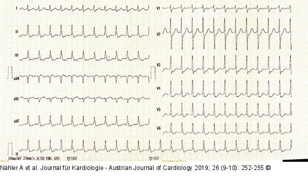 EKG