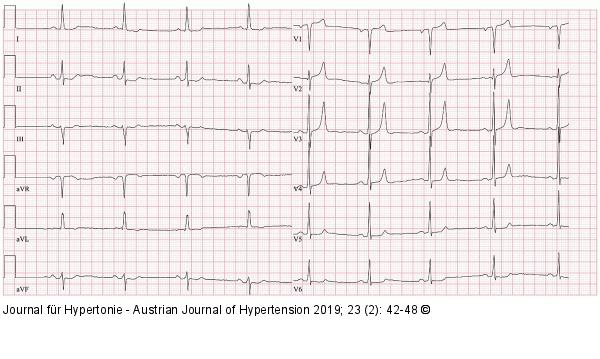 EKG
