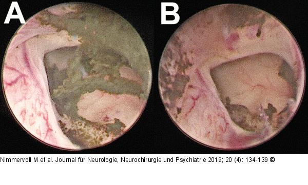 Foramen Monroi