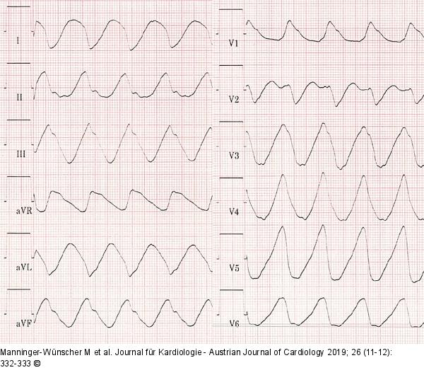 EKG