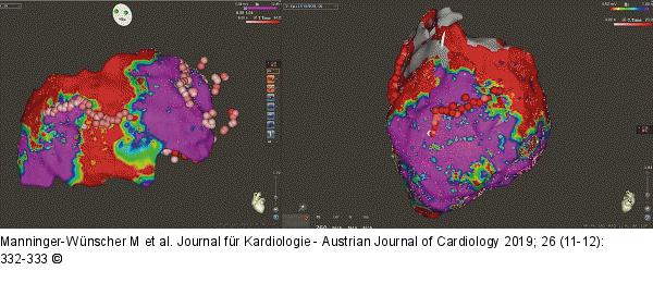 Epikardiales Mapping