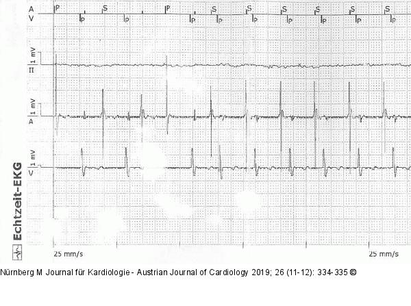 Intrakardiales EKG
