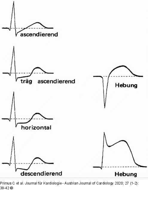 ST-Streckenvernderungen