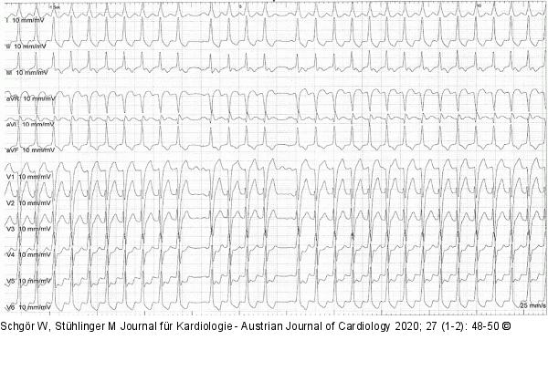 EKG