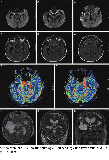 Status epilepticus
