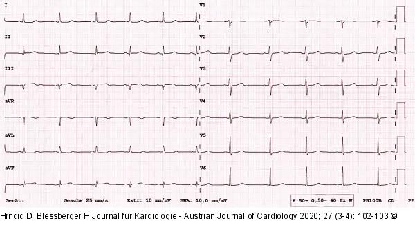 EKG nach Intervention