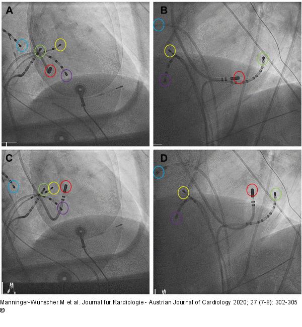 Katheterablation
