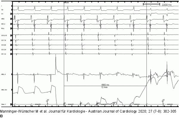 Ablation