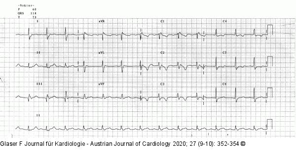 Ruhe-EKG