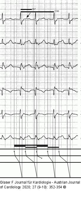 Belastungs-EKG  Leiterdiagramm