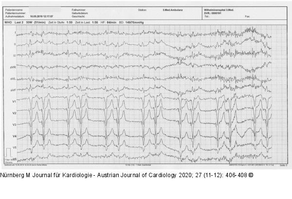 EKG
