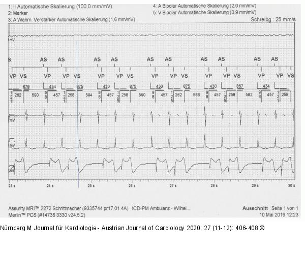 EKG