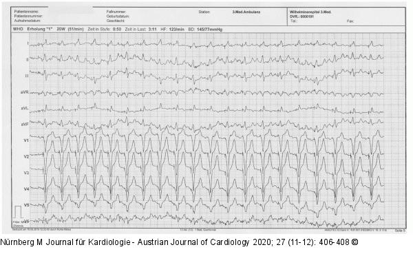 EKG