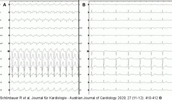 EKG