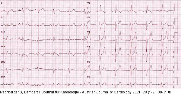 EKG