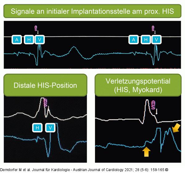 His-Bündel-Pacing