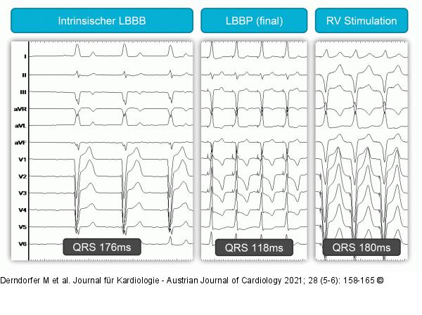 QRS-Komplex