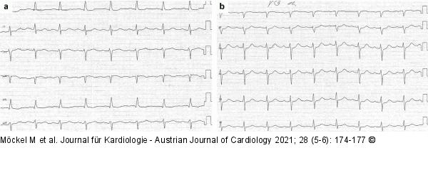 EKG
