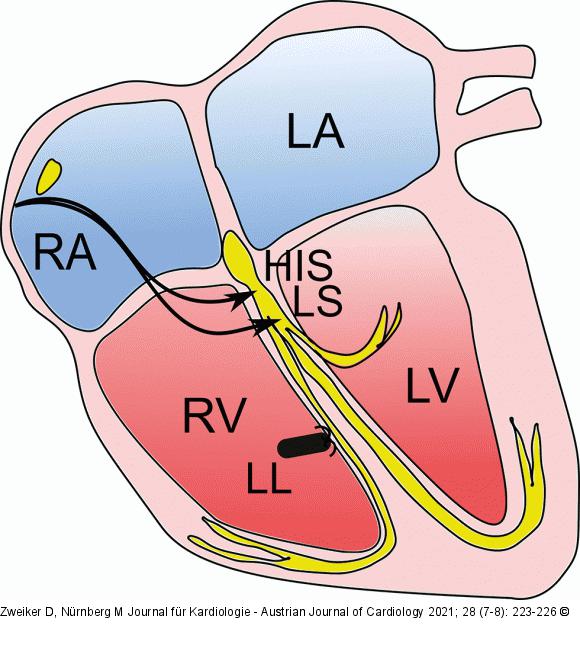 Antibradykardes System