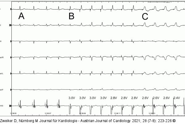 EKG