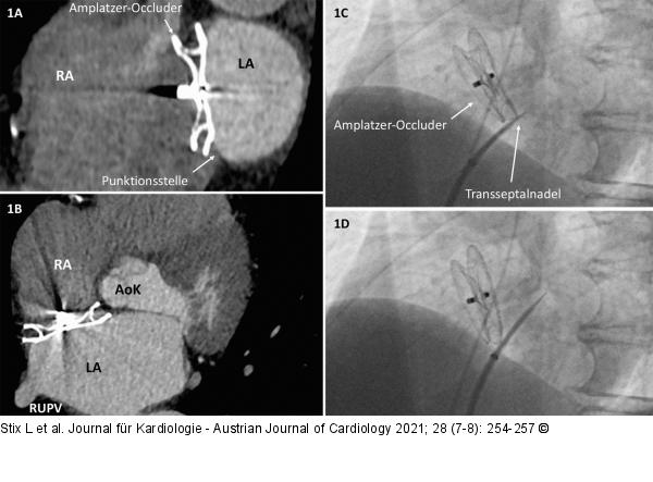 Amplatzer-Septal-Occluder