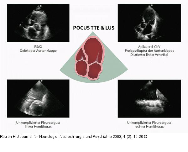 POCUS TTE & LUS - PSAX