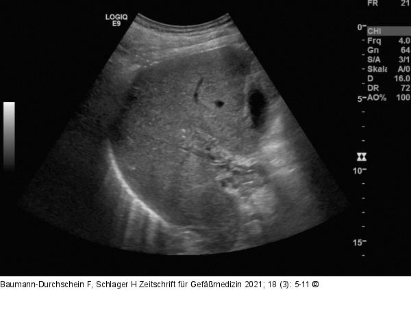 Pfortaderthrombose