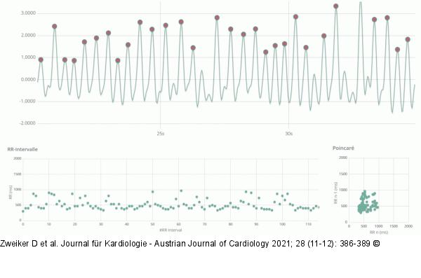 Vorhofflimmerarrhythmie