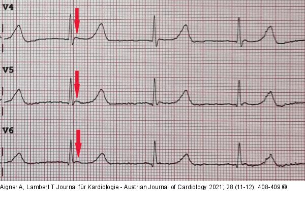 EKG