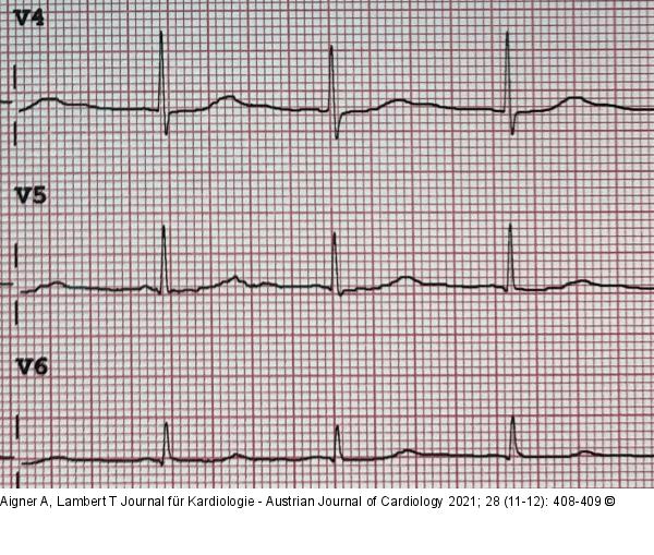 EKG