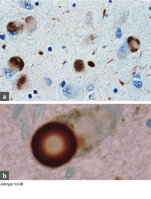 Lewy-Pathologie