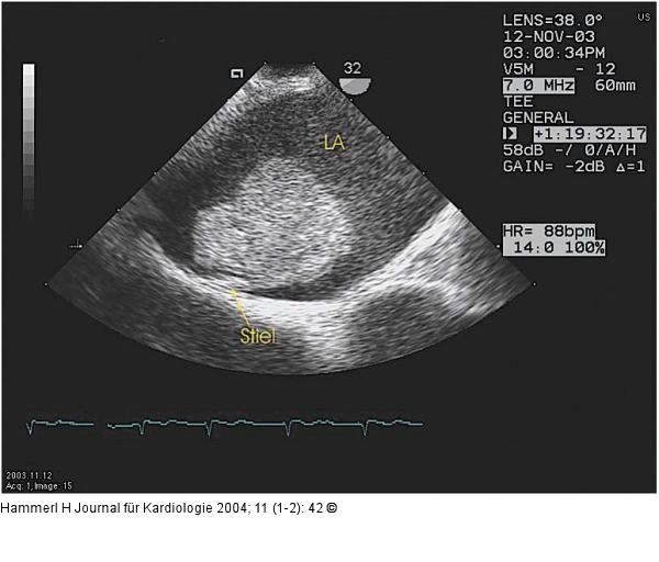 Gestielter Vorhofthrombus
