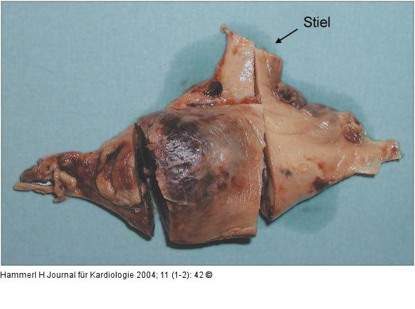Gestielter Vorhofthrombus