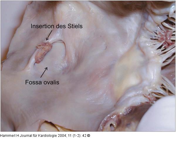 Gestielter Vorhofthrombus