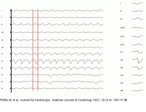 Oberflchen-EKG