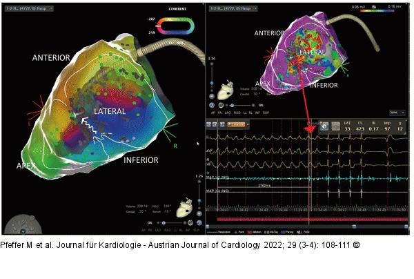 Intrakardiales EKG