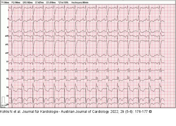 EKG