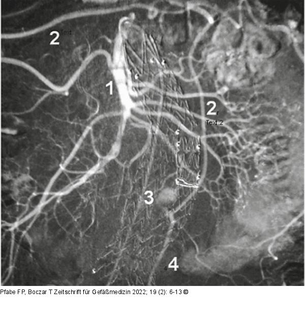 Arteria mesenterica superior 