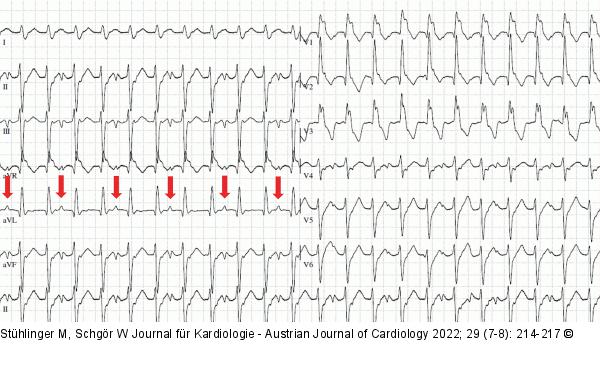 EKG