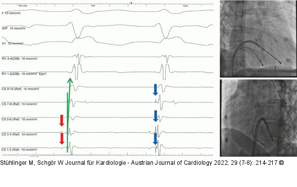 EKG