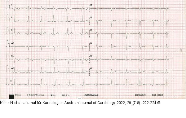 EKG