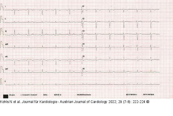 EKG