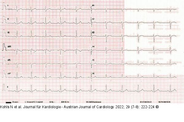 EKG