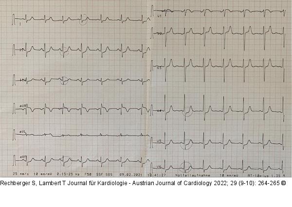EKG