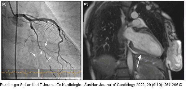Angiogramm - Herz-MRT