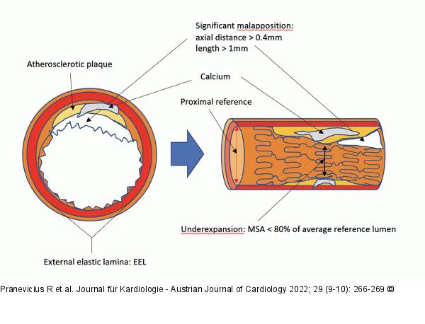 Drug-eluting Stent